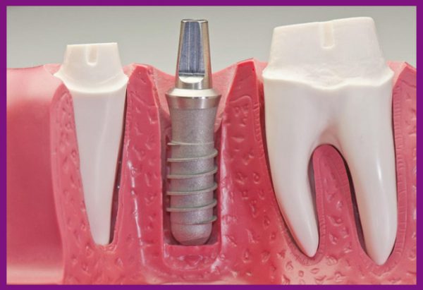 cấy ghép implant là biện pháp phục hình răng tiên tiến nhất hiện nay