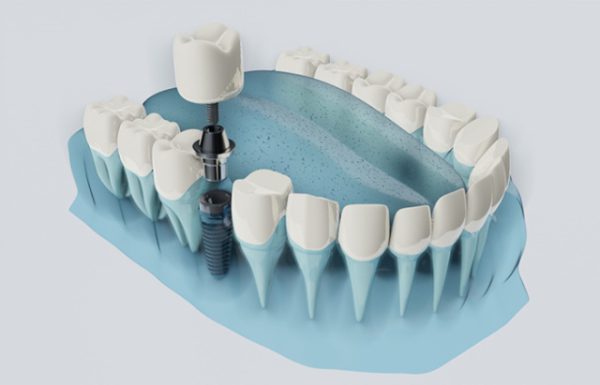 Những câu hỏi thường gặp về cấy ghép rang implant