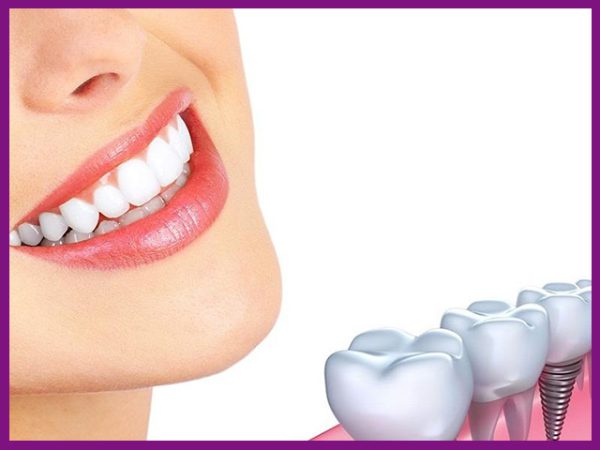 Răng Implant loại nào tốt