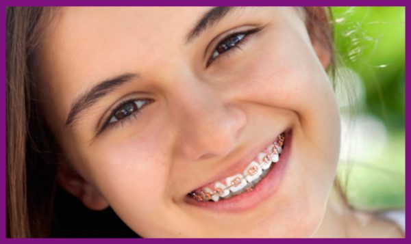 cần chăm sóc kỹ lưỡng trong suốt quá trình niềng răng để không bị tình trạng sâu răng tái phát