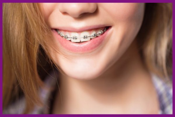 răng bị sâu ở mức độ nhẹ thì vẫn có thể niềng răng được