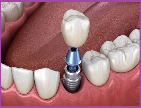 Cấu tạo răng sứ implant gồm 3 phần