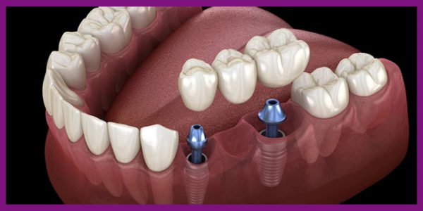 Phục hình răng sứ sau cấy ghép răng implant