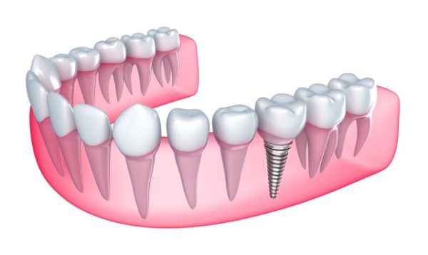 Quy trình phục hình răng sứ sau khi cắm implant