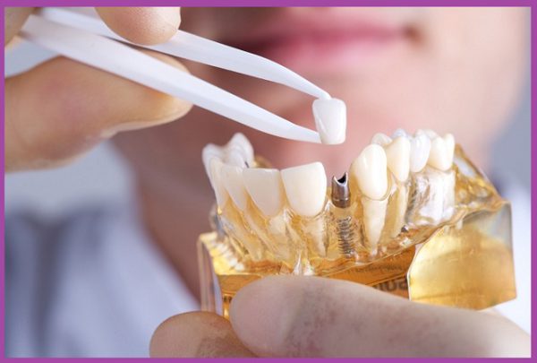 tác dụng phụ của trồng răng implant
