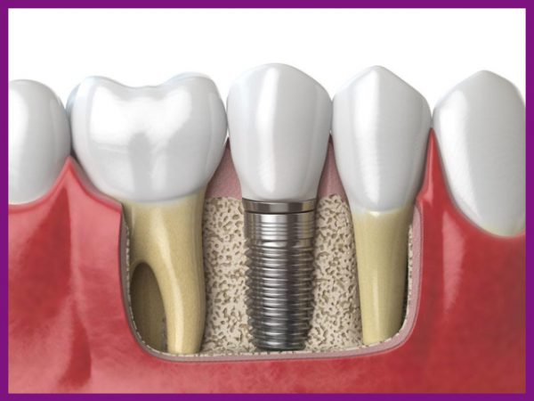 trồng răng implant - kỹ thuật phục hình răng đã mất tối ưu nhất hiện nay