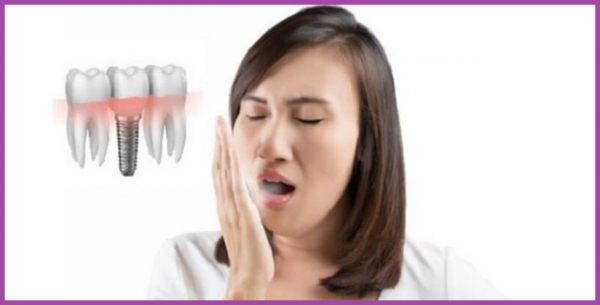 trồng răng Implant có bị hôi miệng không vậy
