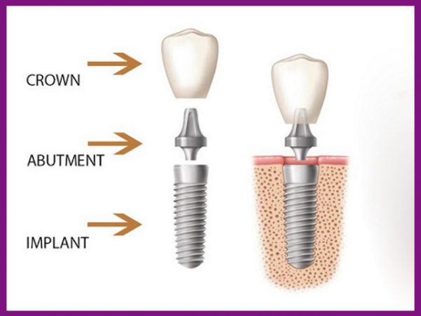 hình ảnh minh họa cấu tạo của một răng implant hoàn chỉnh