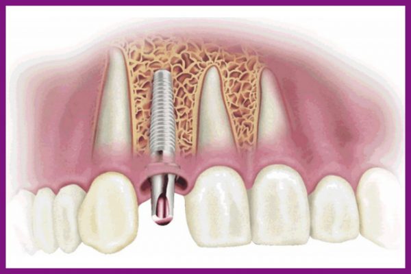 răng implant có thể tồn tại lâu bền với thời gian, nhiều khi lên đến trọn đời