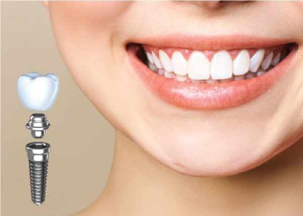 Vì sao trồng răng bằng phương pháp implant lại khá đắt?
