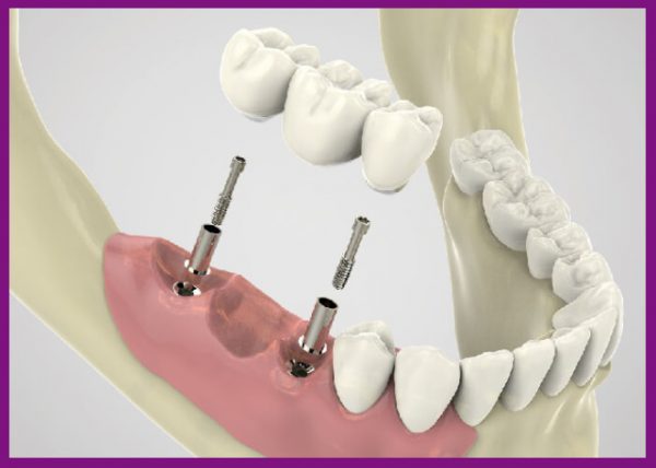 trồng răng bắc cầu dùng cho trường hợp người bệnh mất nhiều răng liên tiếp