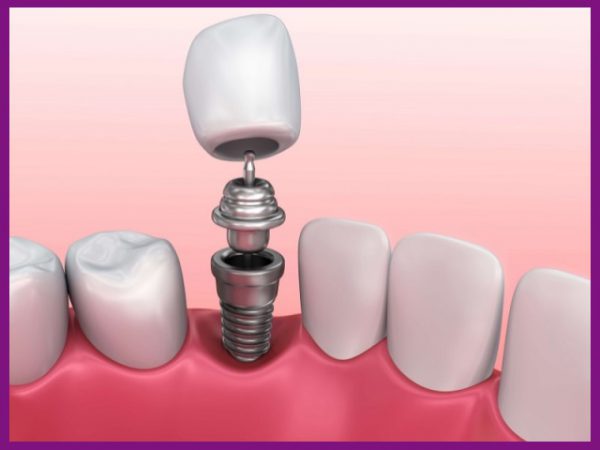 trồng răng bắt vít đơn lẻ dùng để phục hồi lại một răng đã mất ở các vị trí khác nhau
