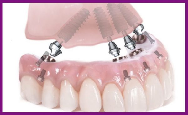 trồng răng implant all on 4 thích hợp với răng hàm dưới hơn