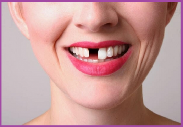 trồng răng cấy ghép Implant khi mất răng