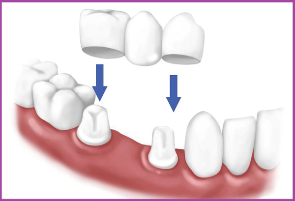 trồng răng cấy ghép Implant 4