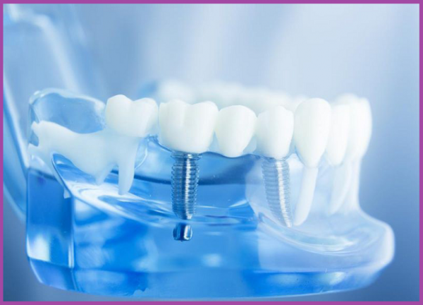 trồng răng cấy ghép Implant uy tín