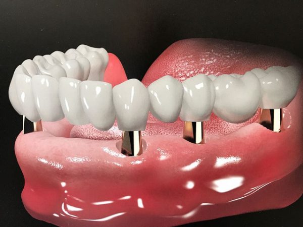 trồng răng giả implant