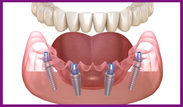 cấy implant thích hợp với những người mất răng hàm dưới hoàn toàn