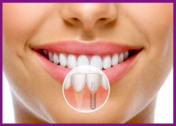 trồng răng hàm dưới bằng implant là biện pháp phục hồi răng hiệu quả nhất hiện nay