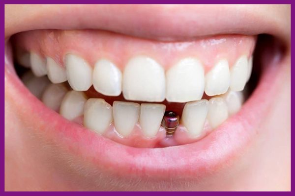 trồng răng hàm implant