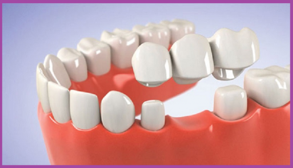 trồng răng hàm số 7 đảm bảo
