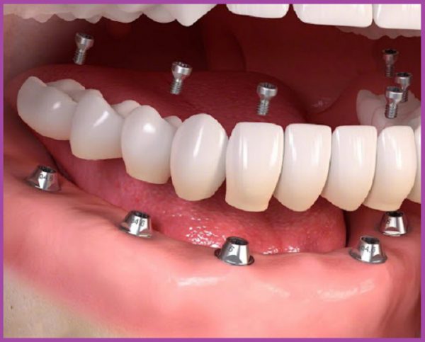 Trồng răng implant toàn hàm All on 6