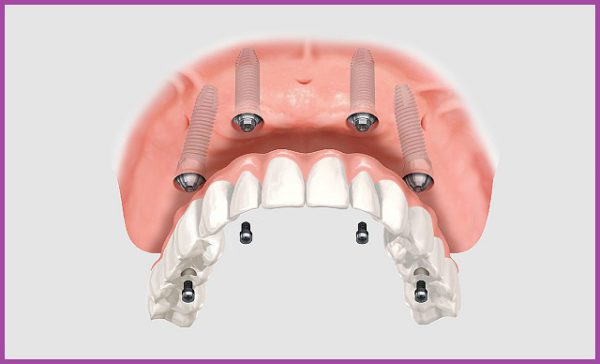 Trồng răng implant nguyên hàm