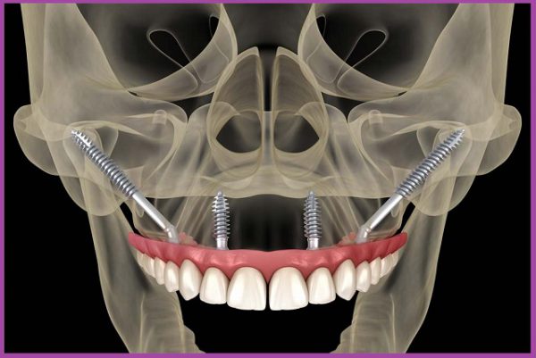 Trồng răng implant nguyên hàm All On 4