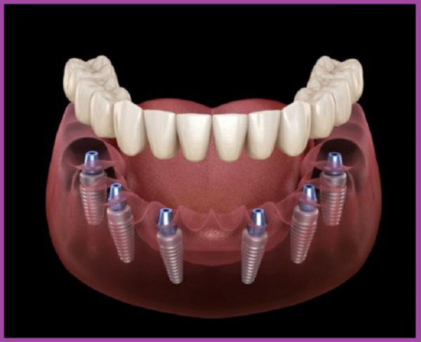 Trồng răng implant nguyên hàm all on 6