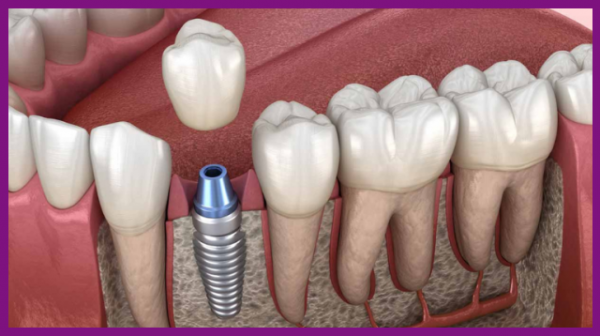 trụ implant sẽ thay thế chân răng thật làm tất cả các nhiệm vụ ăn nhai hàng ngày