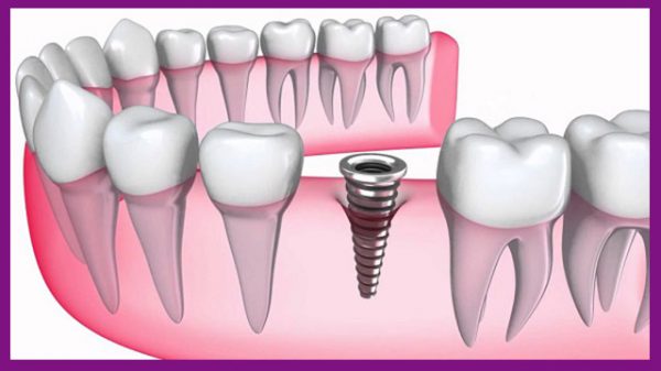 Trồng răng implant 