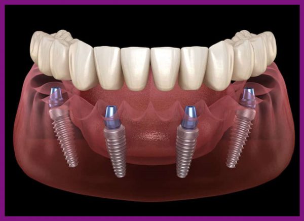 cấy ghép implant - phương pháp phục hồi răng cho chất lượng vượt trội