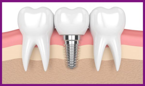 răng implant cho chất lượng thẩm mỹ cao, phục hồi khả năng ăn nhai tốt