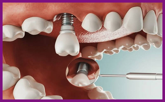 Trồng răng Implant có an toàn không
