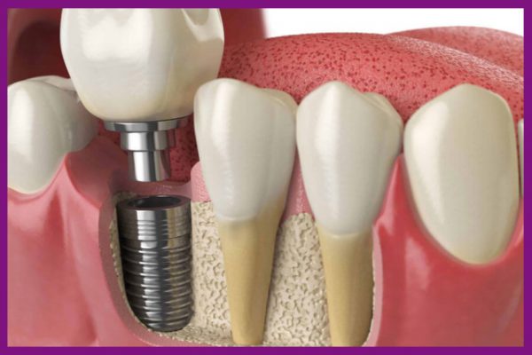 trồng răng implant mang lại giá trị thẩm mỹ cao