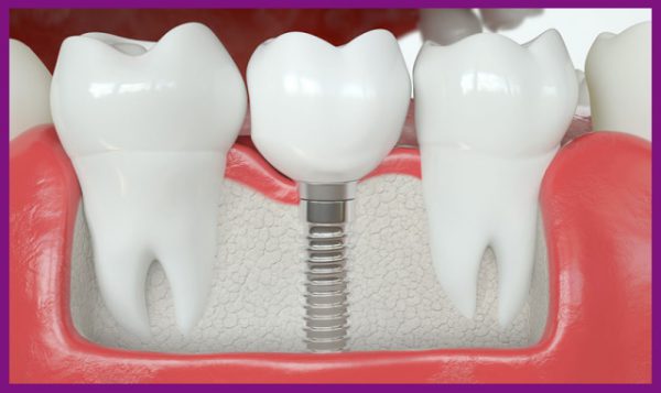 trồng răng implant là giải pháp phục hình răng hiệu quả nhất hiện nay