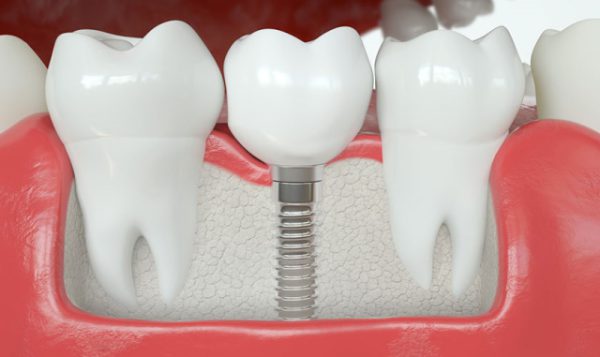 Trồng răng implant có bền không?