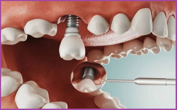 Có thể niềng răng sau khi trồng răng implant 