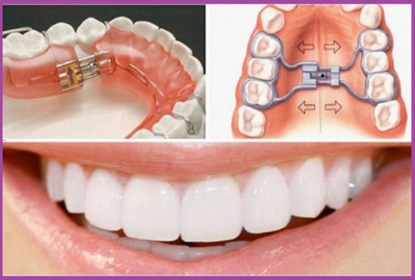 Nhiều trường hợp không niềng răng sau trồng răng implant được