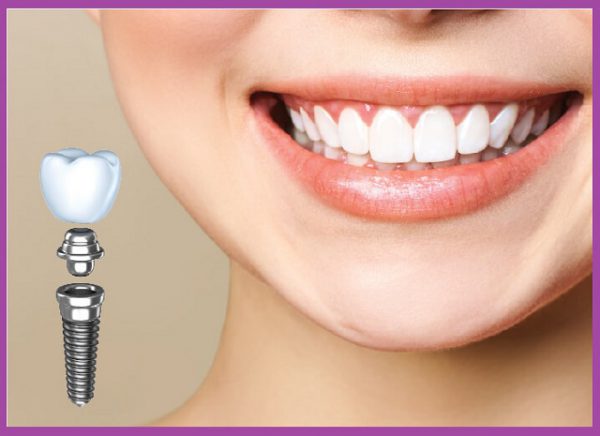 Trồng răng implant là gì?