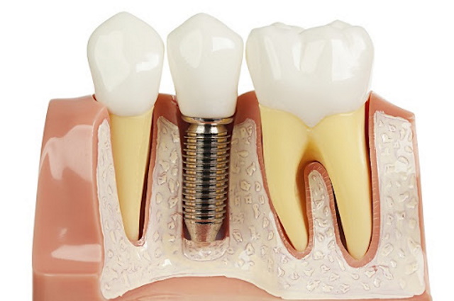Trồng răng implant miễn phí có đảm bảo chất lượng?