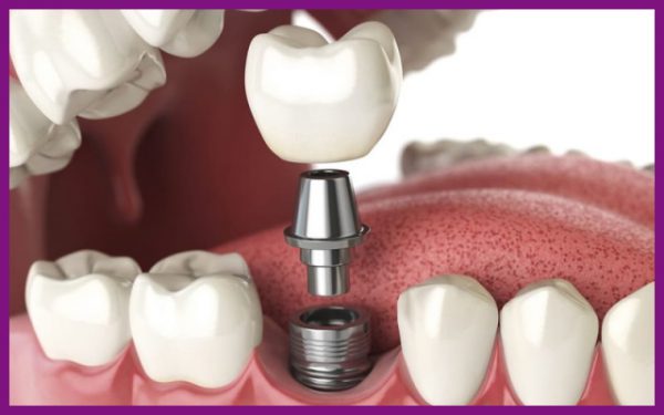răng implant mang lại giá trị thẩm mỹ cao