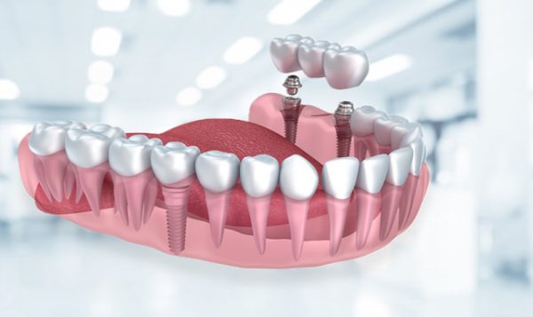 Có nên đi trồng răng implant ở bệnh viện răng hàm mặt trung ương?