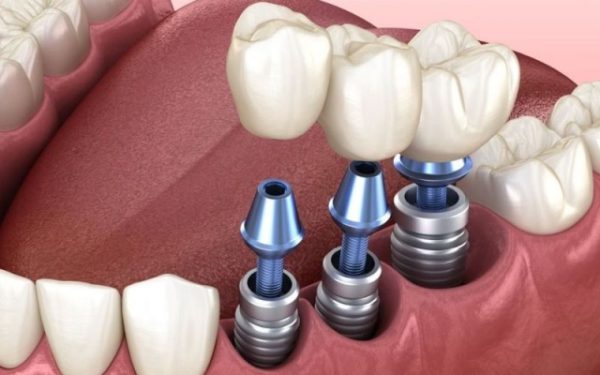 Những điều cần biết về dịch vụ trồng răng implant trả góp