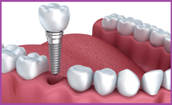 dịch vụ trồng răng implant vinhan 