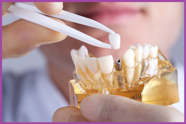 trồng răng implant vinhan 6