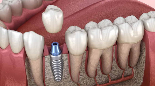 “Trong rang implant” và kinh nghiệm làm răng an toàn
