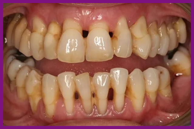 Trồng răng khi mất chân răng có được không