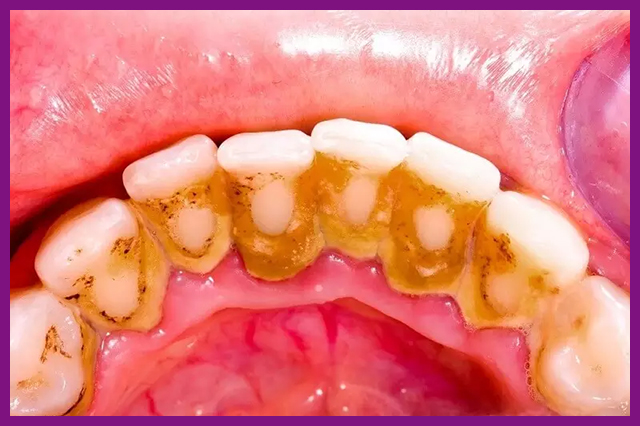 Trồng răng khi mất chân răng được không