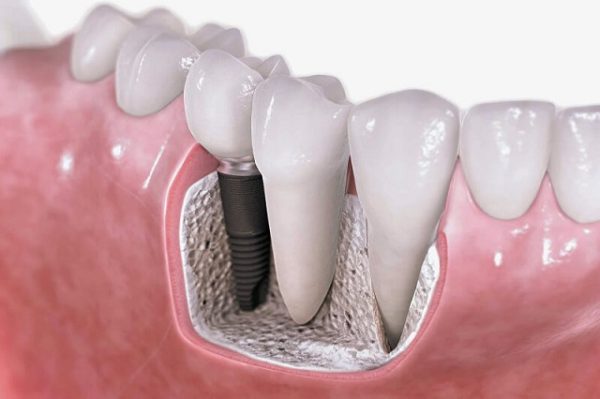 Trồng răng không có chân răng thì nên dùng biện pháp nào?